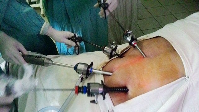 Biến chứng sau phẫu thuật nội soi cắt thận