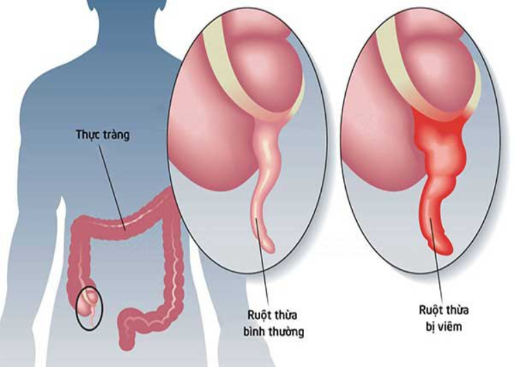 Vì sao cần thực hiện siêu âm trong chẩn đoán viêm ruột thừa cấp?