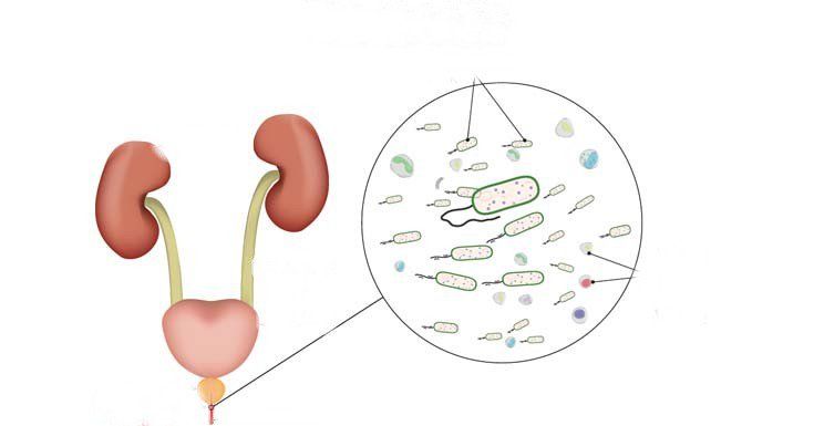 Bệnh do nhiễm Chlamydia Trachomatis sinh dục – tiết niệu