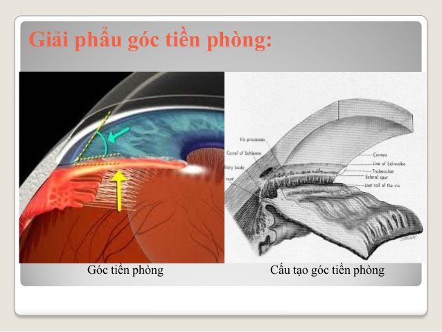 Soi góc tiền phòng đánh giá tình trạng góc tiền phòng