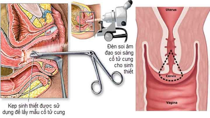Tổng quan về soi và sinh thiết cổ tử cung