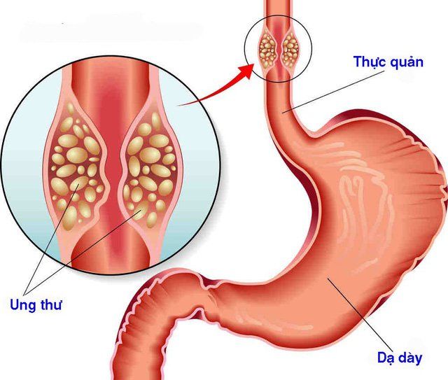 Béo phì - Sự tiềm ẩn ung thư