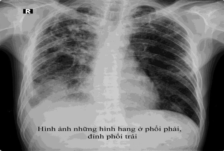 Ý nghĩa của chụp X Quang lồng ngực