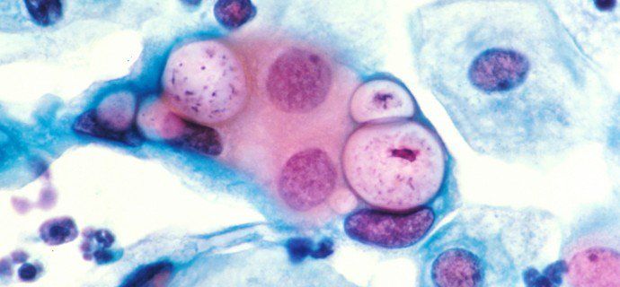 Bệnh do nhiễm Chlamydia Trachomatis sinh dục – tiết niệu