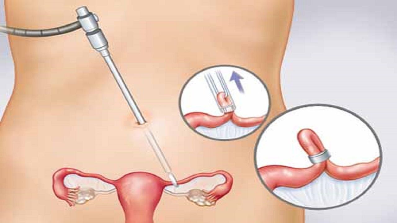 Thắt ống dẫn trứng là gì?
