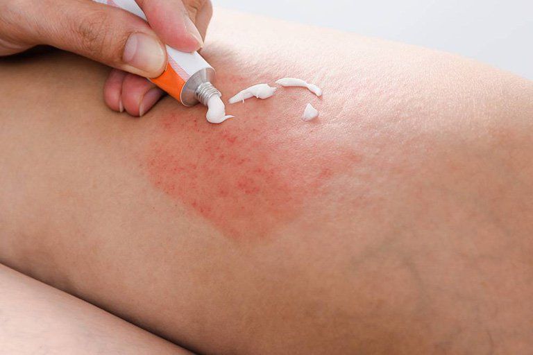 Mometasone furoate là thuốc chữa bệnh về da