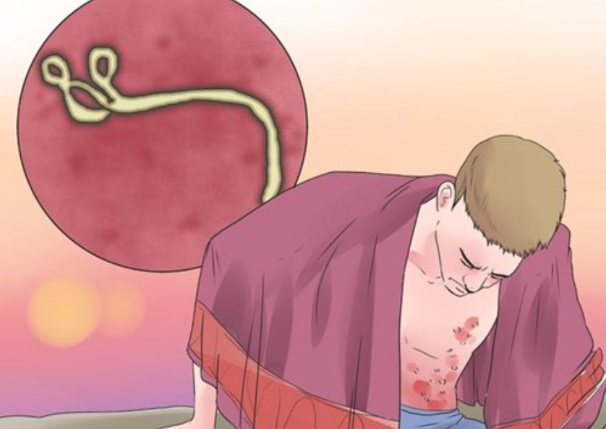 Chẩn đoán và điều trị bệnh do virus Ebola theo hướng dẫn của Bộ Y tế