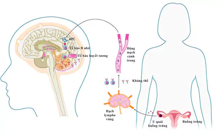Tìm hiểu về căn bệnh viêm não tự miễn