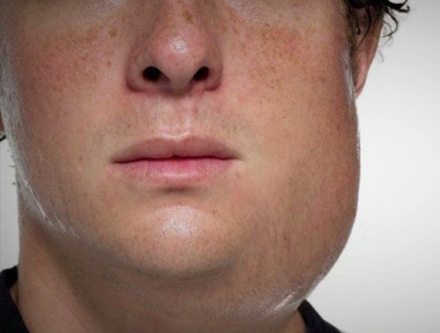 Có vắc-xin quai bị riêng không hay tất cả là vắc-xin phối hợp?