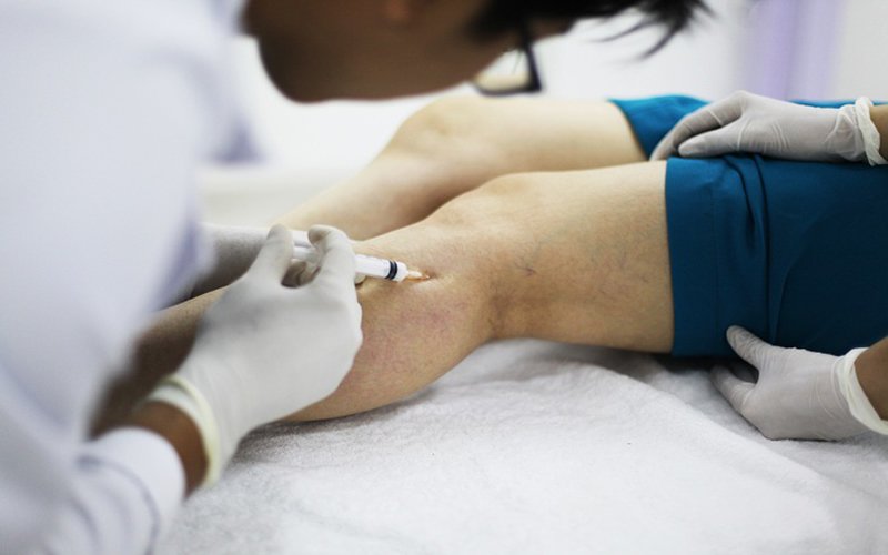 Chỉ định và các loại thuốc điều trị suy giãn tĩnh mạch chân