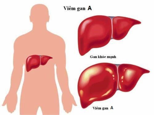 Tổng quan về viêm gan virus: Tất cả những điều bạn cần biết
