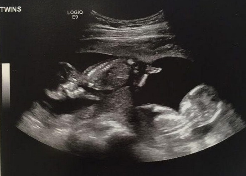 Những hình ảnh siêu âm thai đôi 10 tuần đầy đủ và chân thực nhất để quan sát sự phát triển của em bé