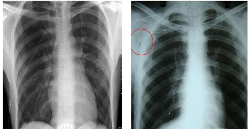 Dấu hiệu dày màng phổi trên hình ảnh chụp x quang