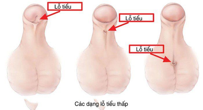 Phẫu thuật lỗ tiểu lệch thấp, tạo hình một thì