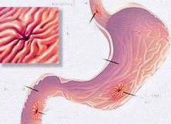 Điều trị hẹp miệng nối thực quản sau phẫu thuật