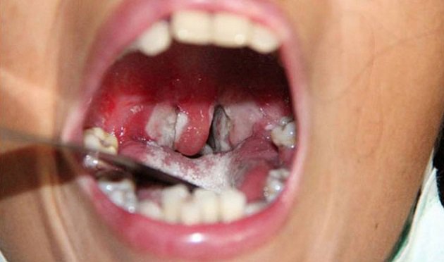 Bệnh bạch hầu lây như thế nào?