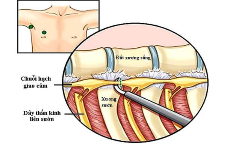 Mục đích của phẫu thuật nội soi cắt hạch giao cảm
