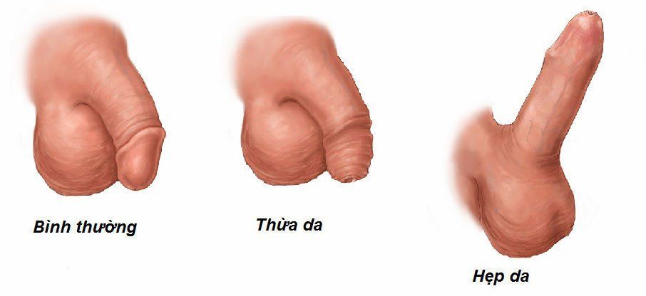 Cách nhận biết và điều trị bệnh viêm niệu đạo không do lậu