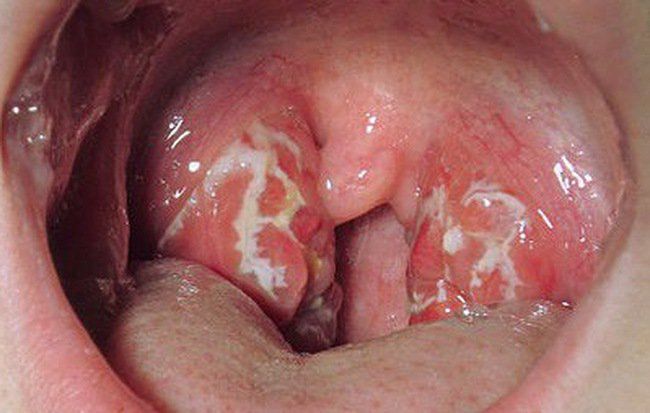 Vi khuẩn nào gây bệnh bạch hầu?