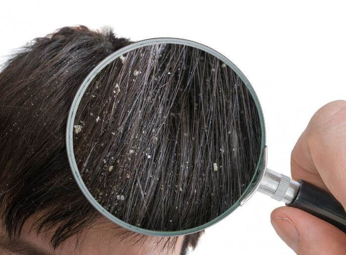 Bệnh vẩy nến da đầu điều trị thế nào?