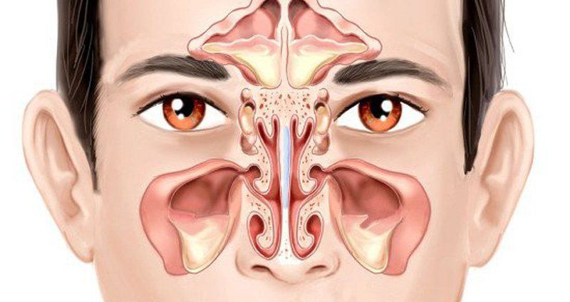 Những điều cần biết về phẫu thuật xoang mũi
