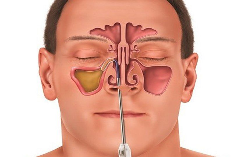 Những điều cần biết về phẫu thuật xoang mũi