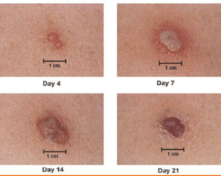 Phòng ngừa thủy đậu bội nhiễm