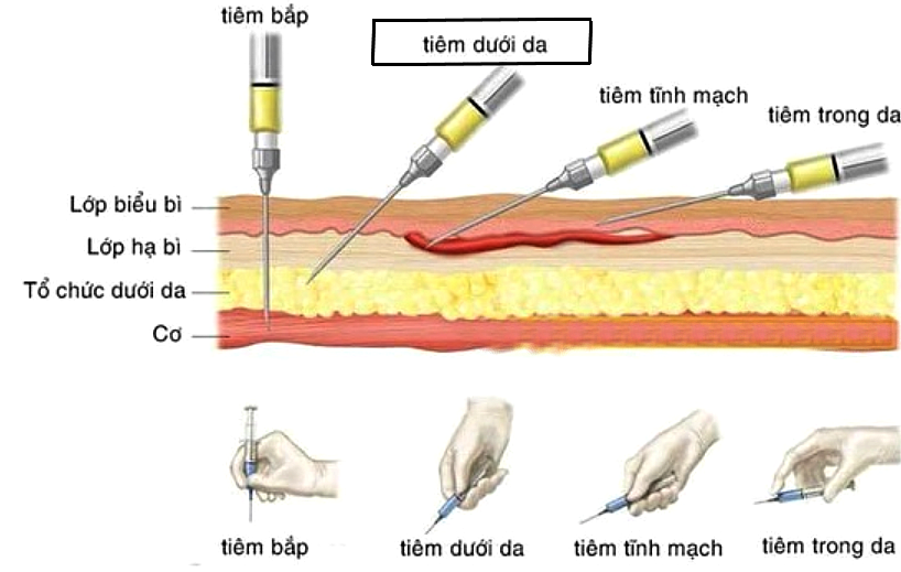 Tìm hiểu kỹ thuật tiêm dưới da