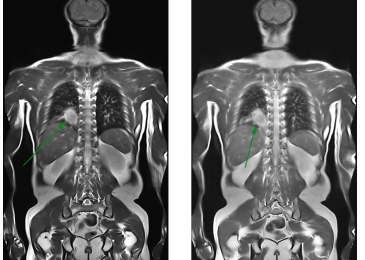 Chụp cộng hưởng từ (MRI) có ảnh hưởng gì tới cơ thể?