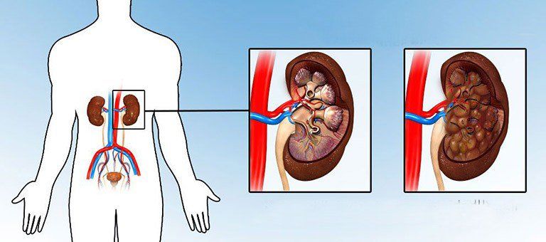Nhiễm trùng đường tiết niệu trên bệnh nhân đái tháo đường