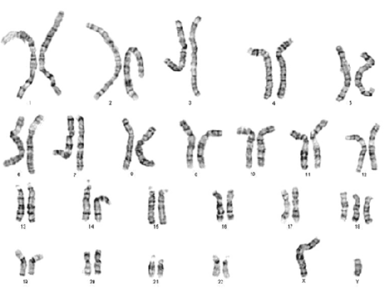 ARSA được xác định trên siêu âm thai như thế nào?