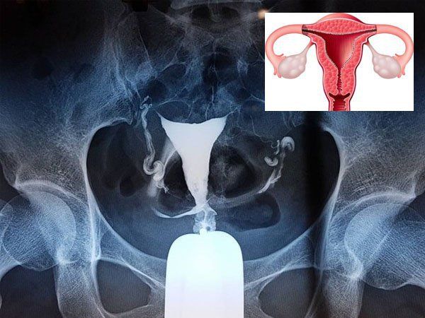 Các chỉ định của chụp HSG (chụp buồng tử cung vòi trứng có cản quang)