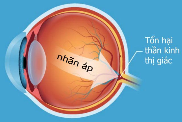 Nhận biết sớm bệnh thiên đầu thống