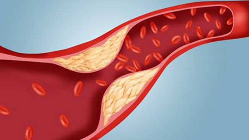 Xơ vữa động mạch và nguy cơ bệnh mạch vành