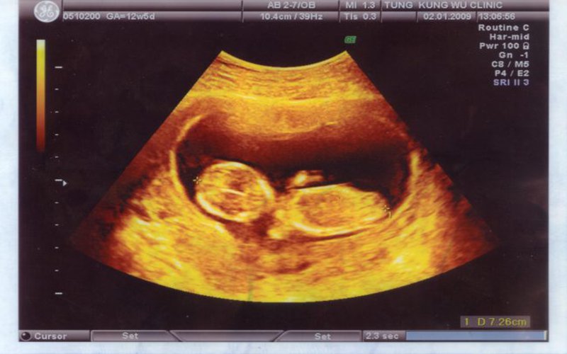 Tung hoành trong không gian bên trong bụng mẹ với kỹ thuật siêu âm thai 3D. Với độ nét cao và khả năng hiển thị chi tiết toàn diện, chiếc máy siêu âm sẽ giúp bạn nhìn thấy bé yêu của mình với tất cả cảm xúc và niềm hạnh phúc.