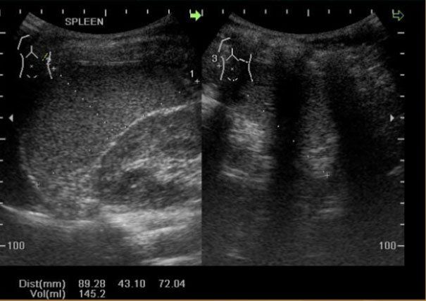 Hình ảnh chẩn đoán lách to trên siêu âm