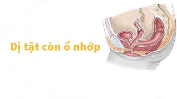 Phẫu thuật điều trị còn ổ nhớp lộ ngoài