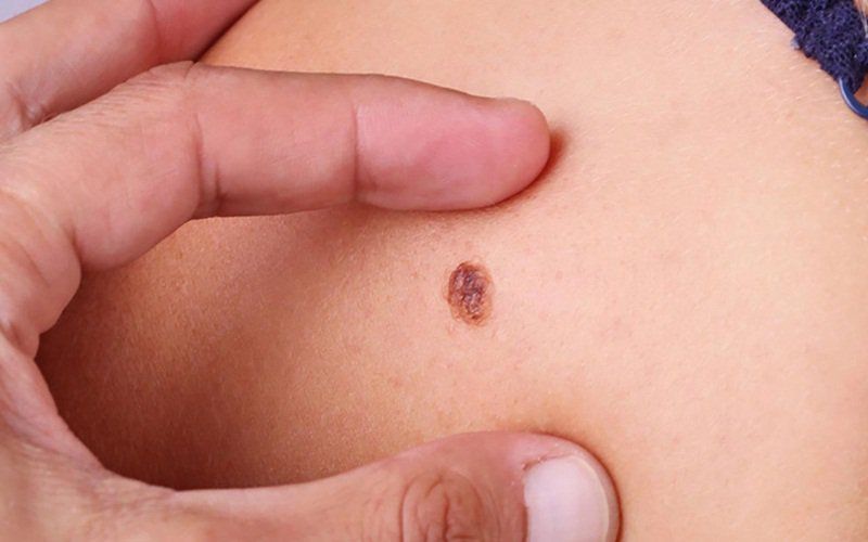 Ý nghĩa xét nghiệm SCC chẩn đoán ung thư biểu mô tế bào vảy