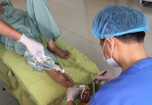 Điều trị gãy xương hở