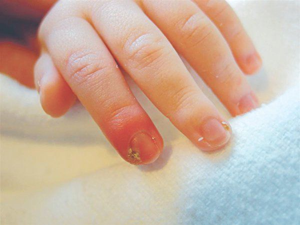 Các thể chín mé thường gặp