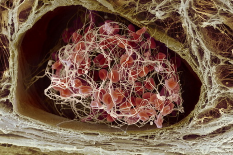 Phân độ và biến chứng sốc bỏng