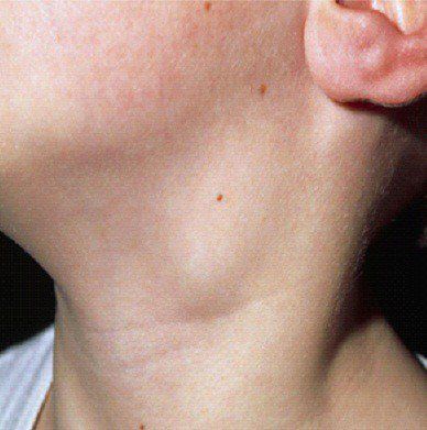 Điều trị U lympho ác tính không Hodgkin