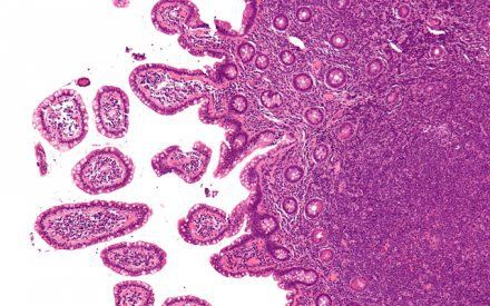 Điều trị U lympho ác tính không Hodgkin