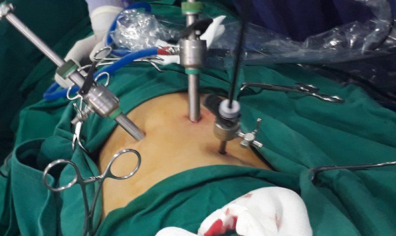 Mổ nội soi cắt nang ống mật chủ