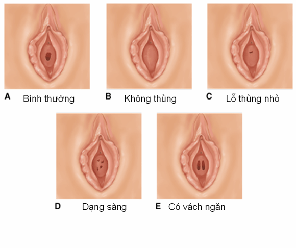 Tạo hình âm đạo thực hiện trong trường hợp nào?