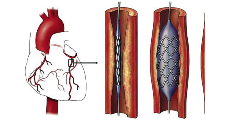 Tái hẹp sau nong mạch và đặt stent