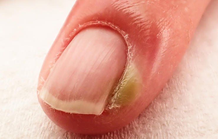 Làm gì khi bị chín mé?