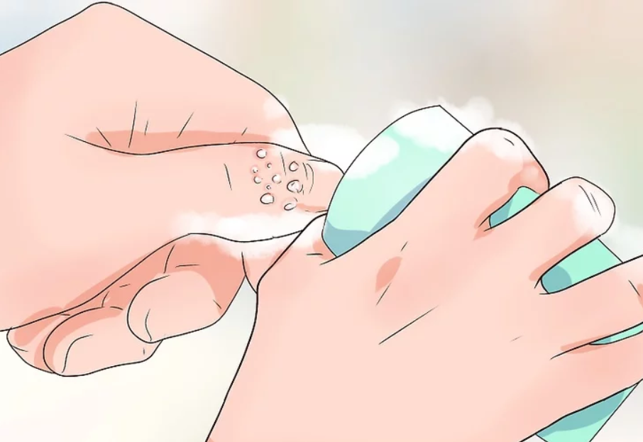 Làm gì khi bị chín mé?