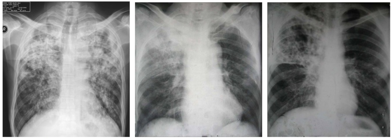 Cơ chế gây bệnh của vi khuẩn lao