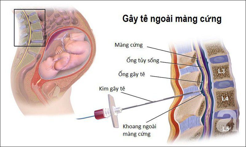 Gây tê ngoài màng cứng giảm đau sau mổ